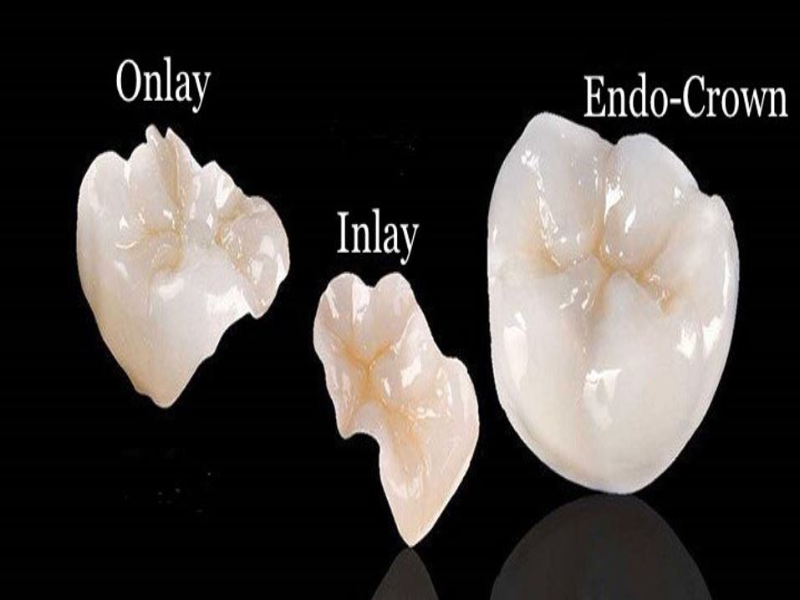 Типы реставраций. Керамическая вкладка емакс. Керамическая вкладка на зуб. Керамическая накладка на зуб.
